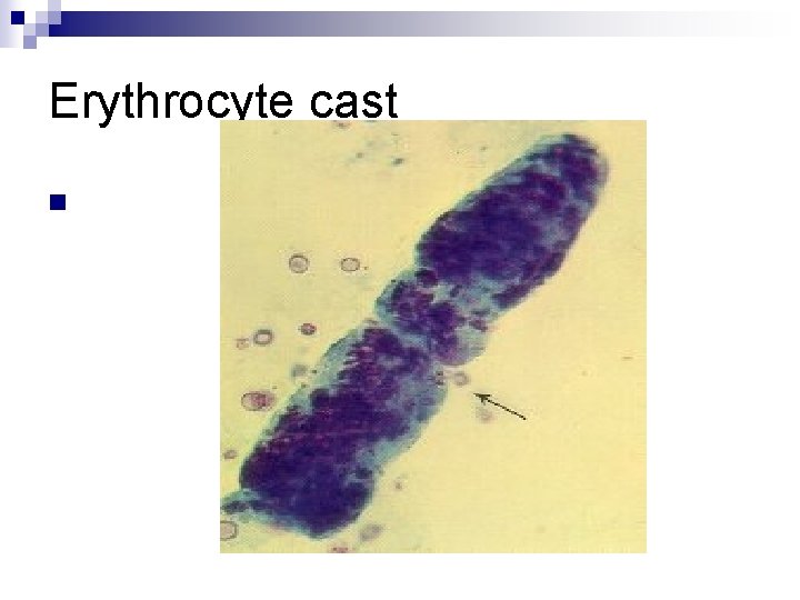 Erythrocyte cast n 