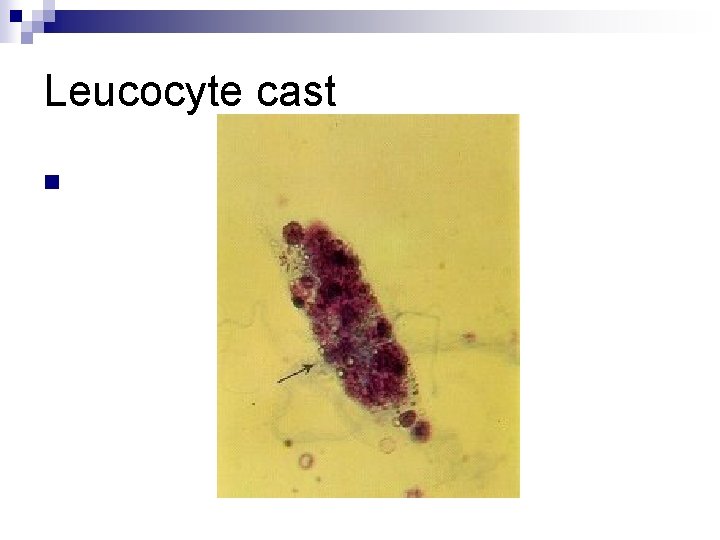 Leucocyte cast n 