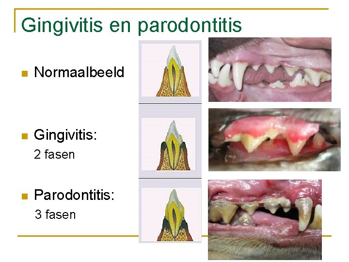 Gingivitis en parodontitis n Normaalbeeld n Gingivitis: 2 fasen n Parodontitis: 3 fasen 