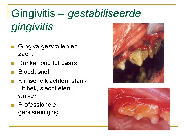 Gingivitis – gestabiliseerde gingivitis n n n Gingiva gezwollen en zacht Donkerrood tot paars