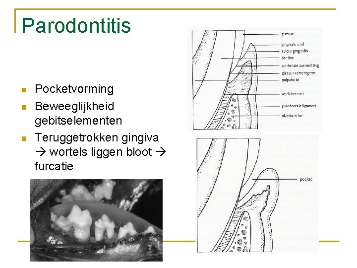 Parodontitis n n n Pocketvorming Beweeglijkheid gebitselementen Teruggetrokken gingiva wortels liggen bloot furcatie 