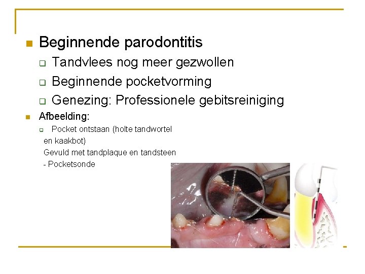 n Beginnende parodontitis q q q n Tandvlees nog meer gezwollen Beginnende pocketvorming Genezing:
