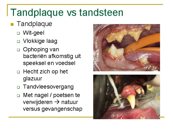 Tandplaque vs tandsteen n Tandplaque q q q Wit-geel Vlokkige laag Ophoping van bacteriën