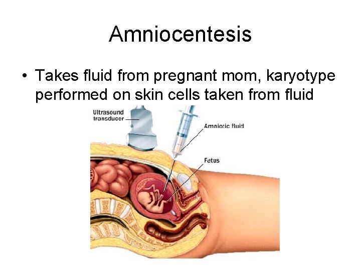 Amniocentesis • Takes fluid from pregnant mom, karyotype performed on skin cells taken from