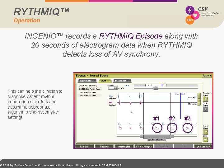 RYTHMIQ™ Operation INGENIO™ records a RYTHMIQ Episode along with 20 seconds of electrogram data