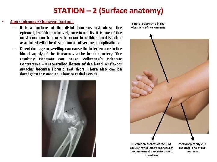 STATION – 2 (Surface anatomy) • Supraepicondylar humerus fracture: – it is a fracture