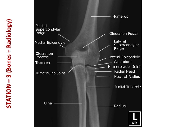 STATION – 3 (Bones + Radiology) 