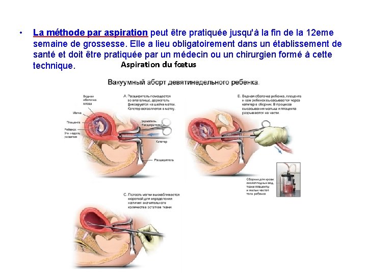  • La méthode par aspiration peut être pratiquée jusqu'à la fin de la