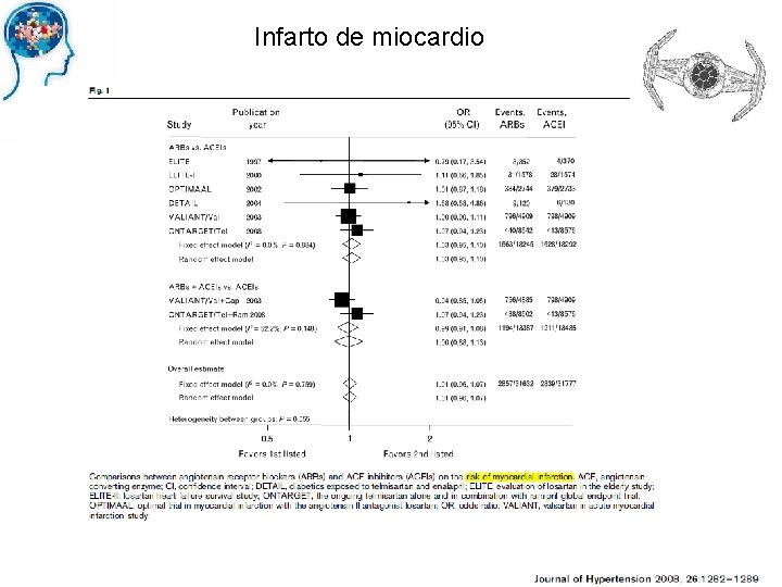 Infarto de miocardio 