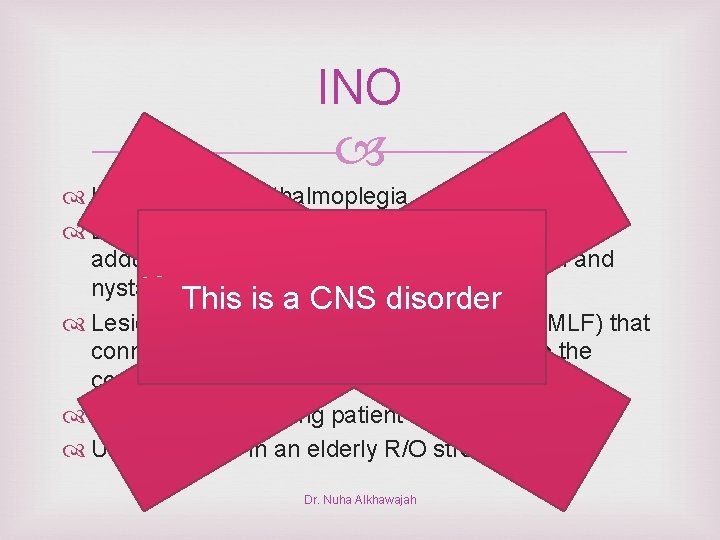 INO Inter-nuclear ophthalmoplegia Disorder of conjugate lateral gaze with impaired adduction of the eye