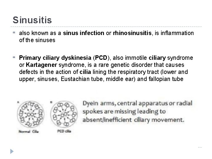 Sinusitis also known as a sinus infection or rhinosinusitis, is inflammation of the sinuses