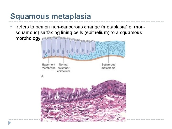 Squamous metaplasia refers to benign non-cancerous change (metaplasia) of (nonsquamous) surfacing lining cells (epithelium)