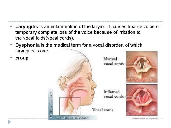  Laryngitis is an inflammation of the larynx. It causes hoarse voice or temporary
