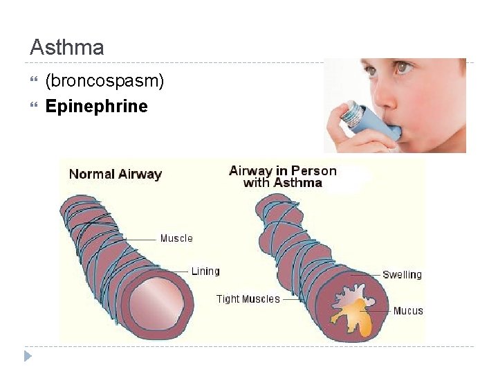 Asthma (broncospasm) Epinephrine 