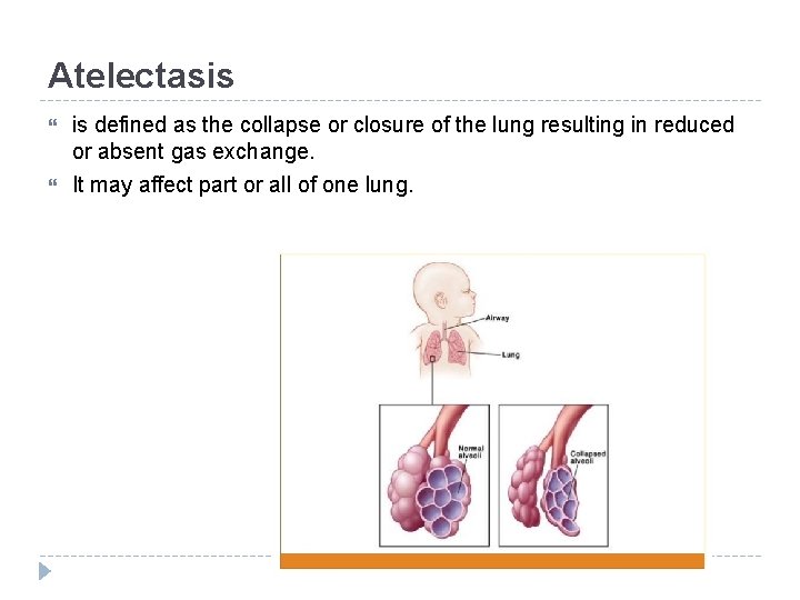 Atelectasis is defined as the collapse or closure of the lung resulting in reduced