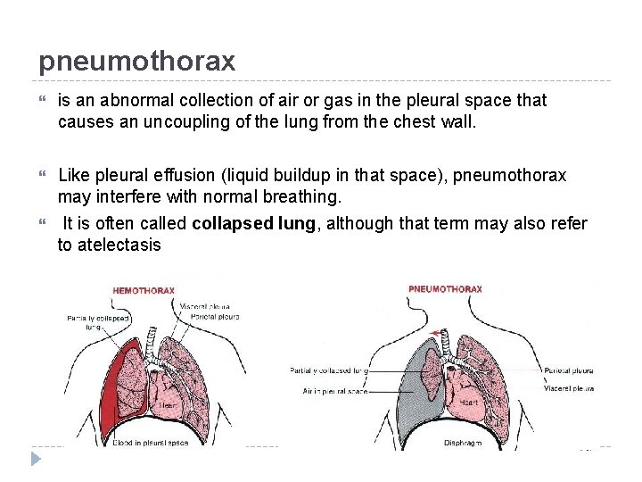 pneumothorax is an abnormal collection of air or gas in the pleural space that