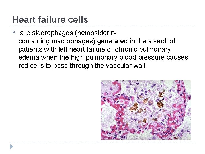Heart failure cells are siderophages (hemosiderincontaining macrophages) generated in the alveoli of patients with