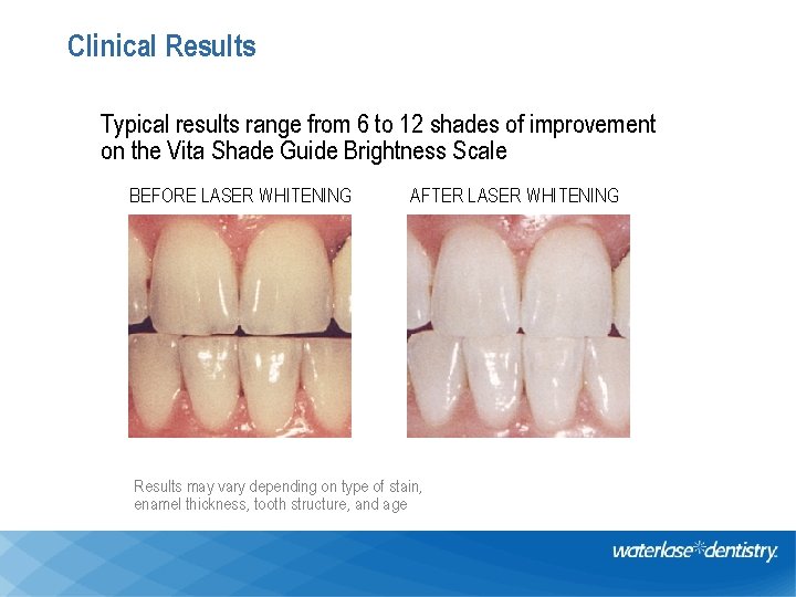 Clinical Results Typical results range from 6 to 12 shades of improvement on the