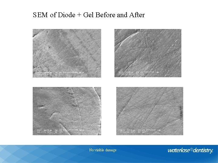 Diode Laser + Gel SEM of Diode + Gel Before and After 1, 5