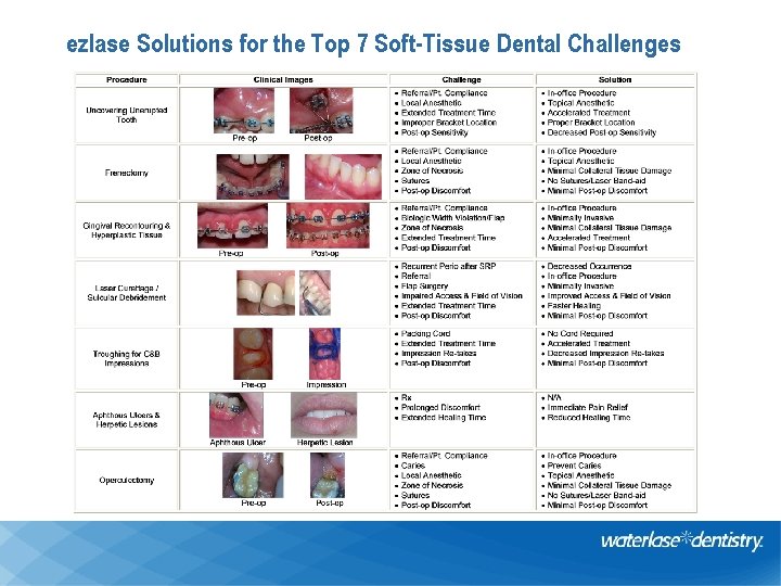 ezlase Solutions for the Top 7 Soft-Tissue Dental Challenges 