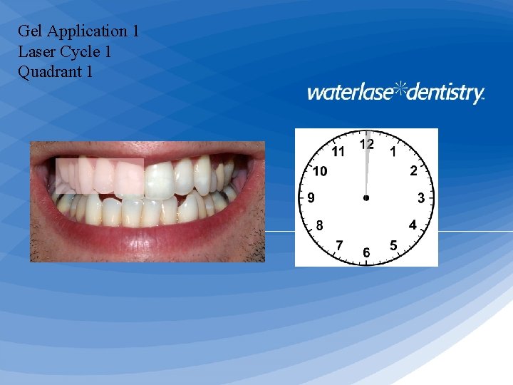 Gel Application 1 Laser Cycle 1 Quadrant 1 