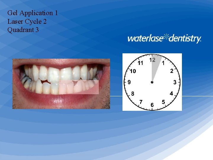 Gel Application 1 Laser Cycle 2 Quadrant 3 