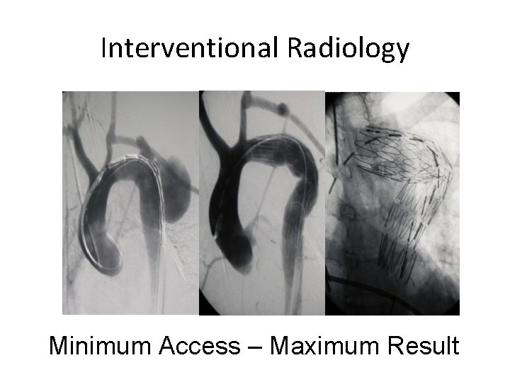 Interventional Radiology Minimum Access – Maximum Result 