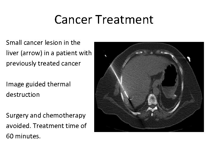 Cancer Treatment Small cancer lesion in the liver (arrow) in a patient with previously