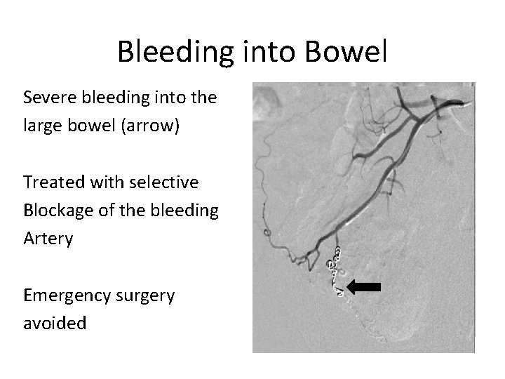 Bleeding into Bowel Severe bleeding into the large bowel (arrow) Treated with selective Blockage