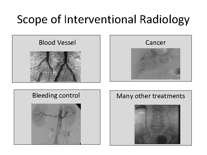 Scope of Interventional Radiology Blood Vessel Bleeding control Cancer Many other treatments 