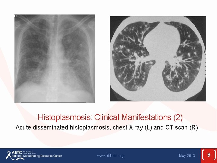 Histoplasmosis: Clinical Manifestations (2) Acute disseminated histoplasmosis, chest X ray (L) and CT scan