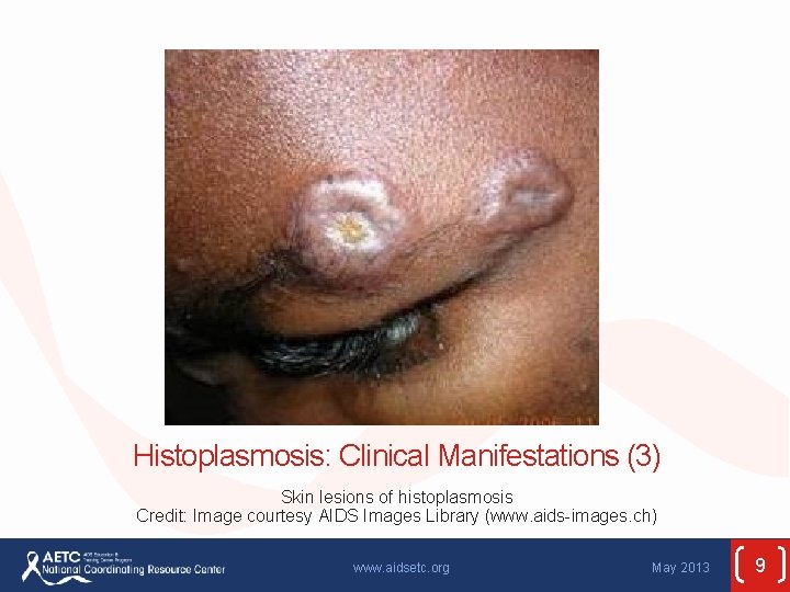 Histoplasmosis: Clinical Manifestations (3) Skin lesions of histoplasmosis Credit: Image courtesy AIDS Images Library