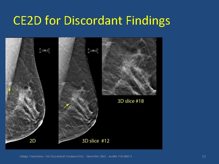 CE 2 D for Discordant Findings Hologic Proprietary - For Educational Purposes Only -
