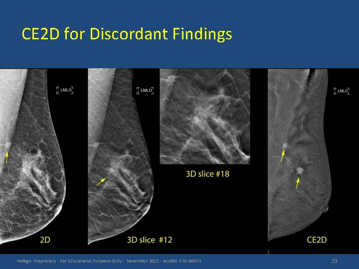 CE 2 D for Discordant Findings Hologic Proprietary - For Educational Purposes Only -