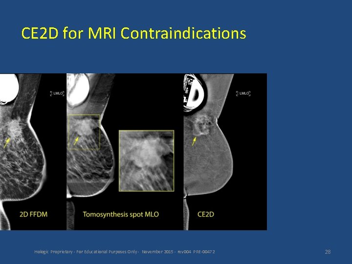 CE 2 D for MRI Contraindications Hologic Proprietary - For Educational Purposes Only -