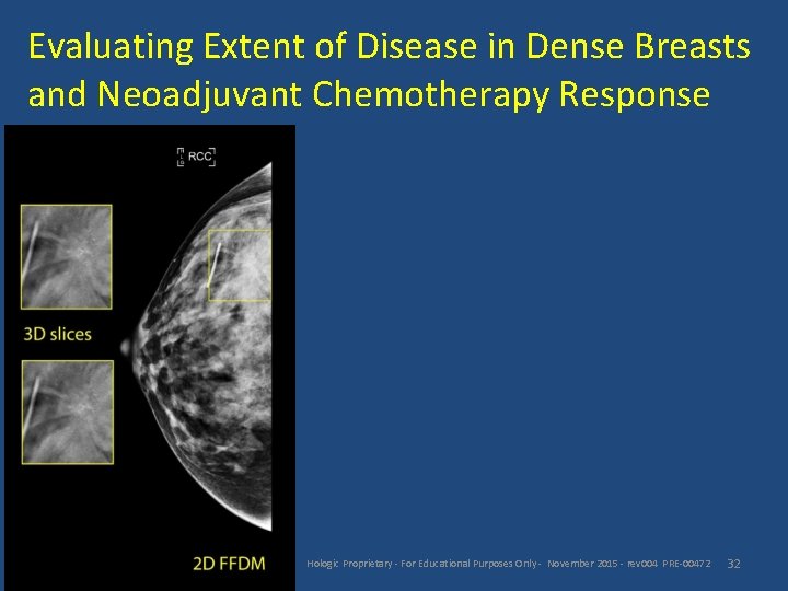 Evaluating Extent of Disease in Dense Breasts and Neoadjuvant Chemotherapy Response Hologic Proprietary -