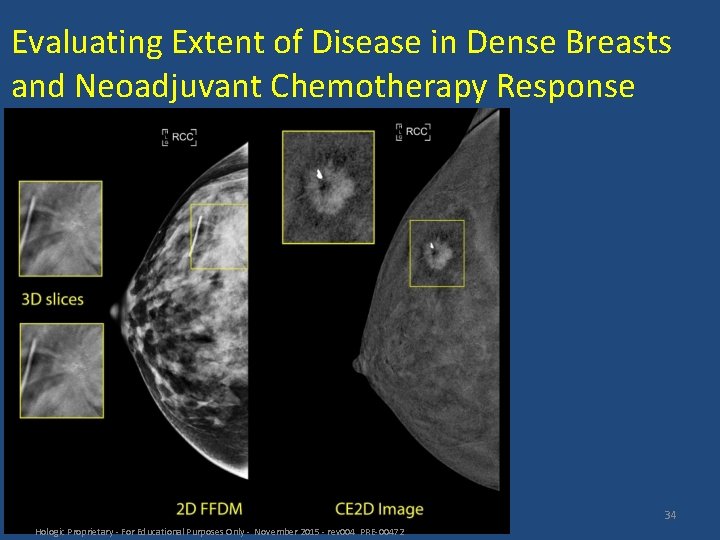 Evaluating Extent of Disease in Dense Breasts and Neoadjuvant Chemotherapy Response 34 Hologic Proprietary