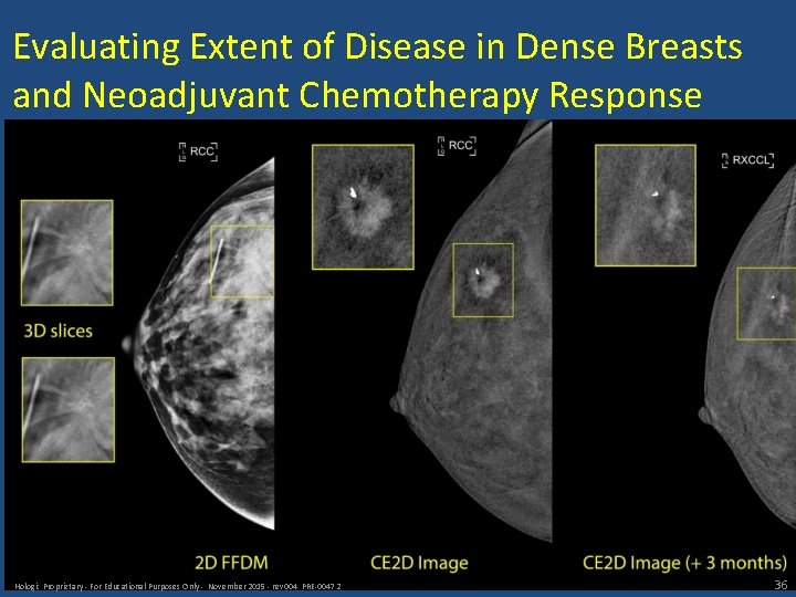 Evaluating Extent of Disease in Dense Breasts and Neoadjuvant Chemotherapy Response Hologic Proprietary -