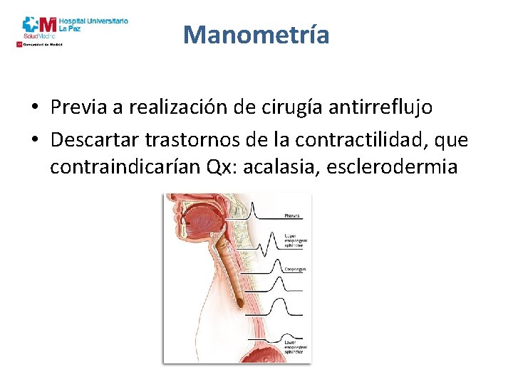 Manometría • Previa a realización de cirugía antirreflujo • Descartar trastornos de la contractilidad,