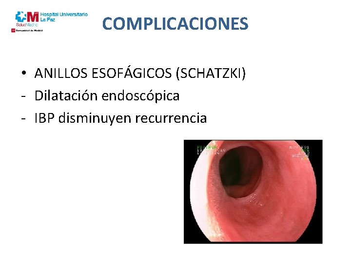 COMPLICACIONES • ANILLOS ESOFÁGICOS (SCHATZKI) - Dilatación endoscópica - IBP disminuyen recurrencia 