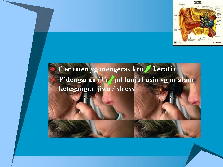 Cerumen yg mengeras krn keratin P’dengaran (+) pd lanjut usia yg m’alami ketegangan jiwa