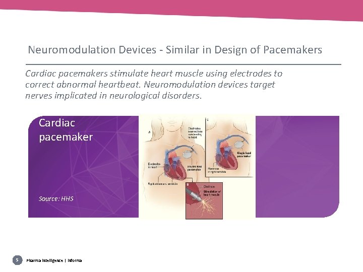 Neuromodulation Devices - Similar in Design of Pacemakers Cardiac pacemakers stimulate heart muscle using