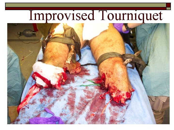 Improvised Tourniquet 