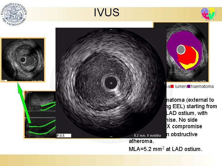 IVUS atheroma lumen haematoma Intramural haematoma (external to and compressing EEL) starting from mid-LAD