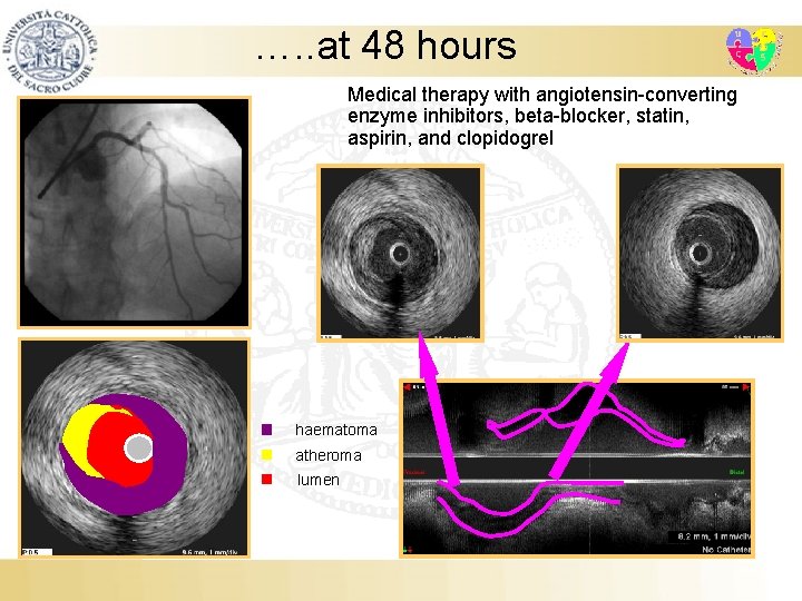 …. . at 48 hours Medical therapy with angiotensin-converting enzyme inhibitors, beta-blocker, statin, aspirin,