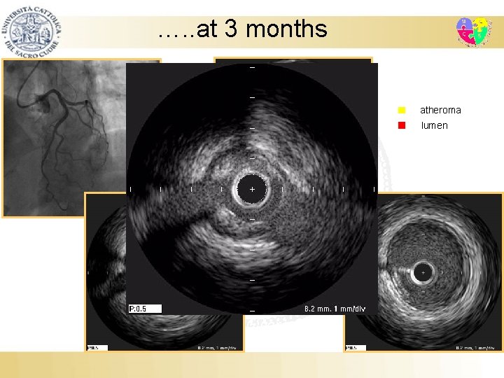 …. . at 3 months atheroma lumen Fondi, 28 Giugno 2008 