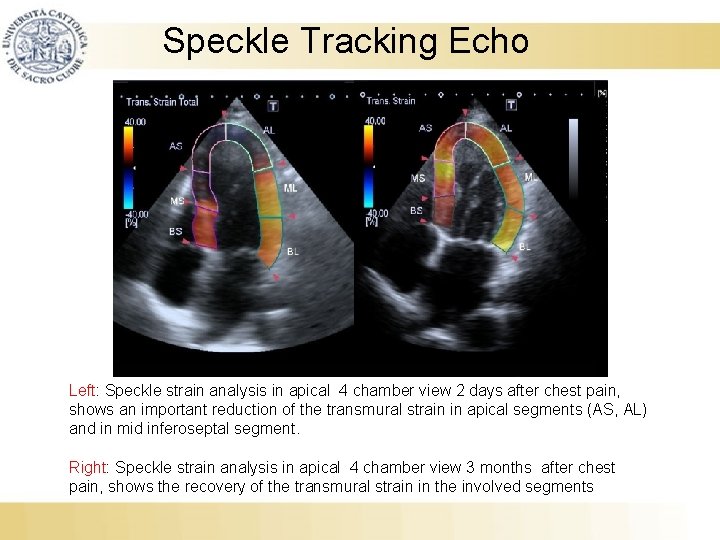 Speckle Tracking Echo Left: Speckle strain analysis in apical 4 chamber view 2 days