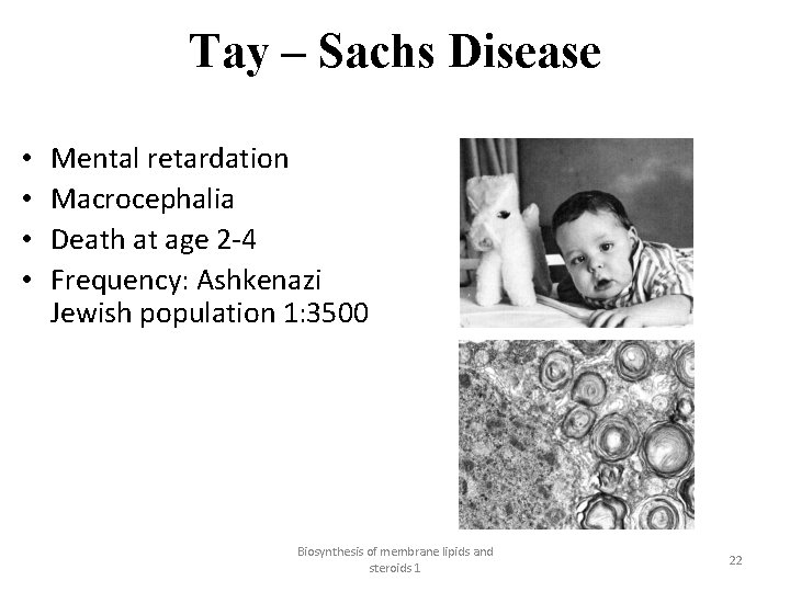 Tay – Sachs Disease • • Mental retardation Macrocephalia Death at age 2 4
