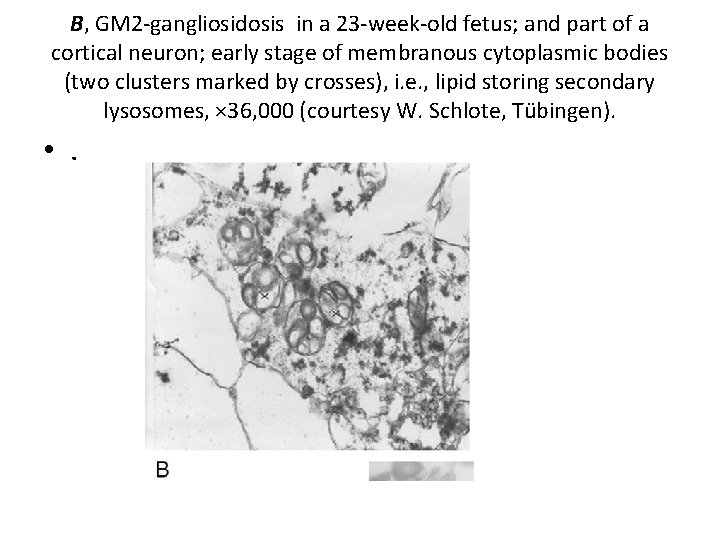 B, GM 2 gangliosidosis in a 23 week old fetus; and part of a