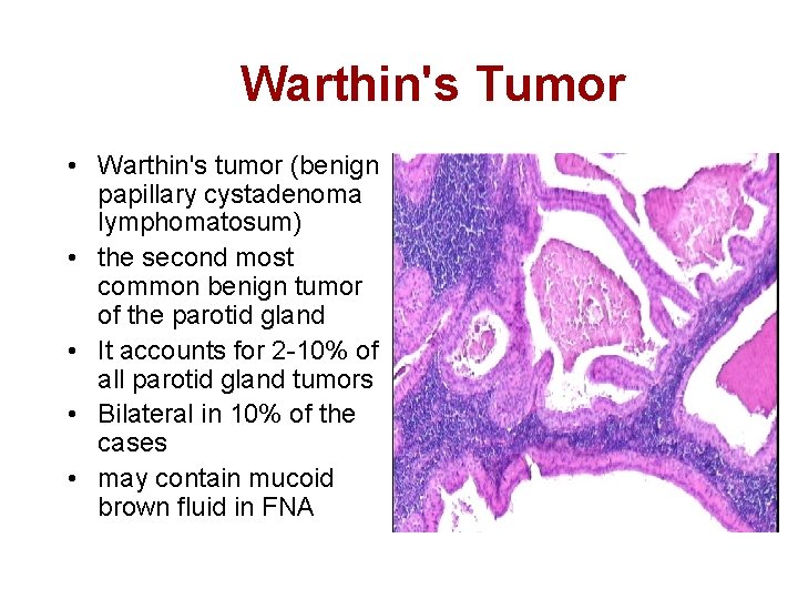 warthin's tumor histology)